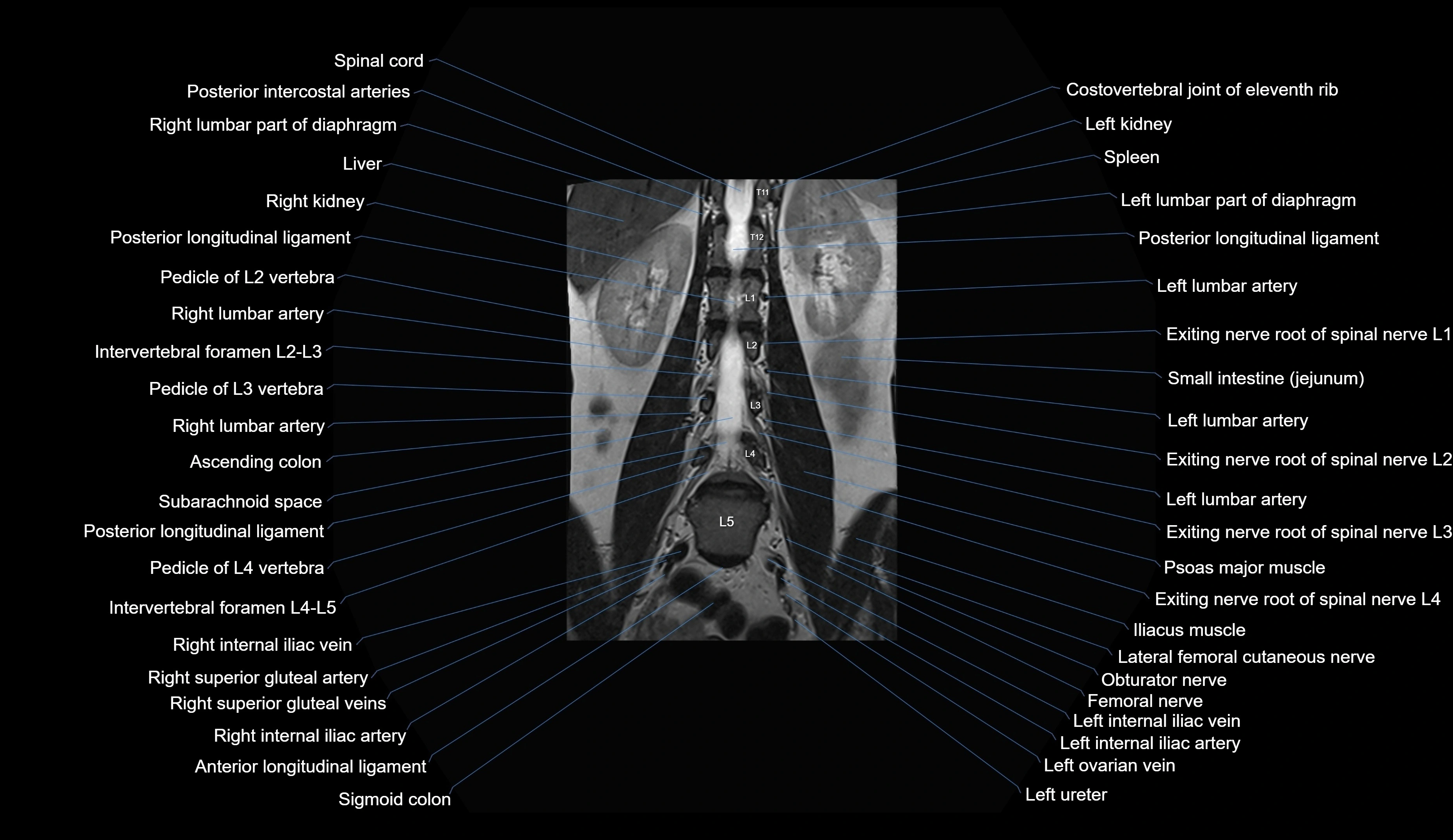 MRI lumbar spine coronal cross sectional anatomy 3T radiology  image-img-00001-00016.webp